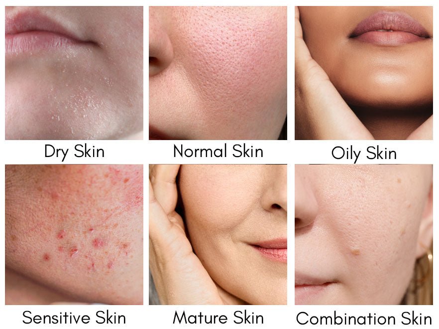 Types of Acne on Different Skin Types and How to Treat Them with Midas Wellness Hub