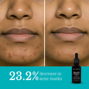 Blemish Balance Serum | Reduces Hyperpigmentation and Acne Marks