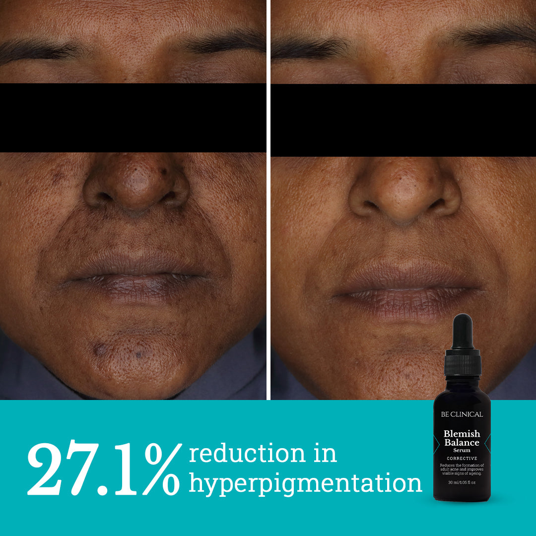 Neck Repair and Blemish Balance | Care for Menopausal Skin