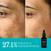 Blemish Balance Serum | Reduces Hyperpigmentation and Acne Marks